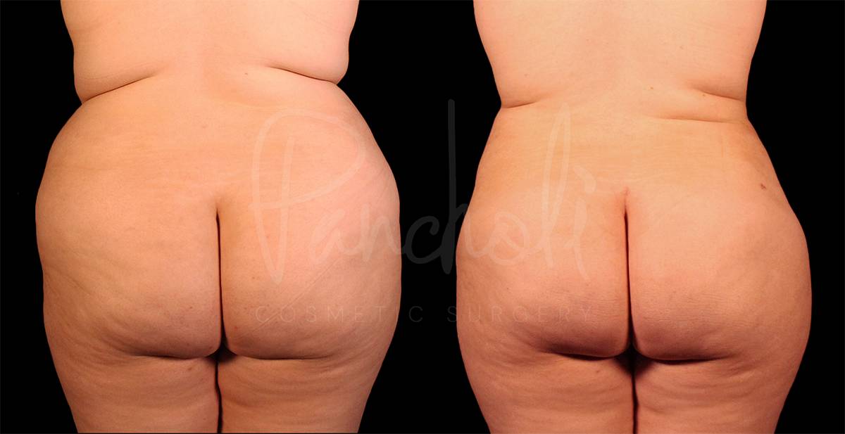 before and after liposuction of the stomach female patient back view case 8060