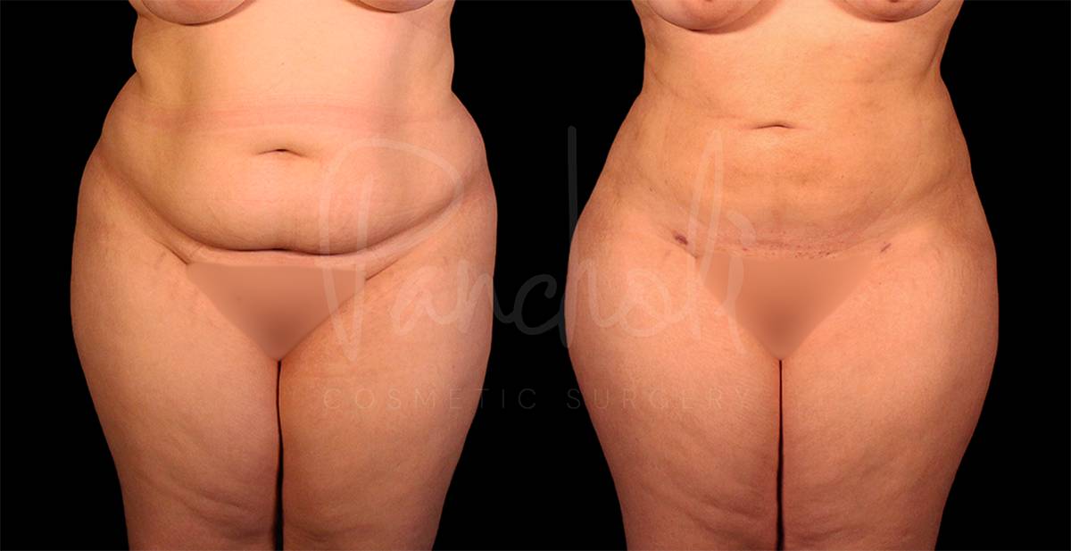 before and after liposuction of the stomach female patient front view case 8060