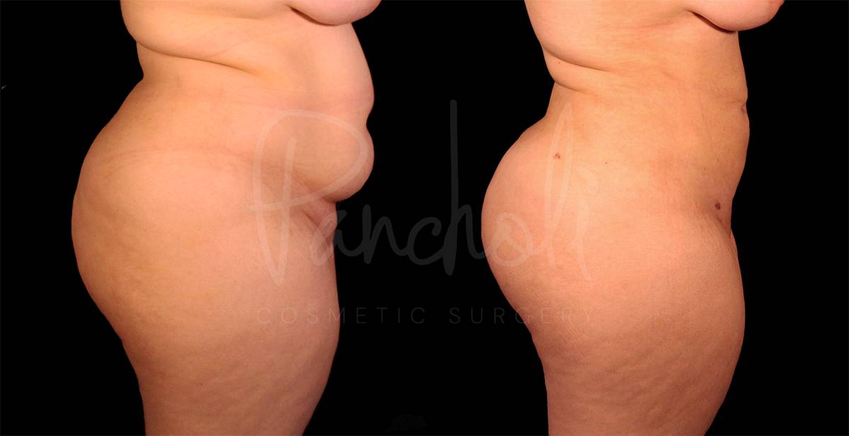 before and after liposuction of the stomach female patient side view case 8060