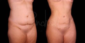 before and after liposuction of the stomach female patient angle view case 8093