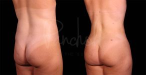 before and after liposuction of the stomach female patient back angle view case 8093