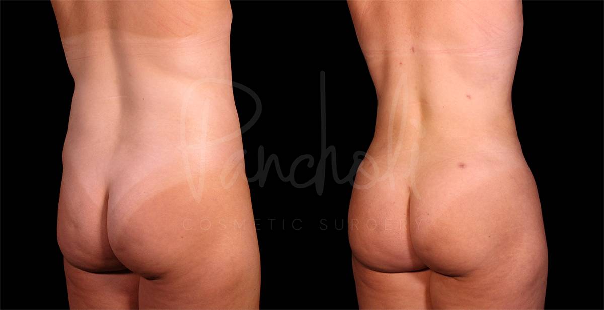 before and after liposuction of the stomach female patient back angle view case 8093