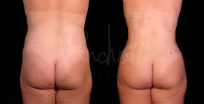 before and after liposuction of the stomach female patient back view case 8093