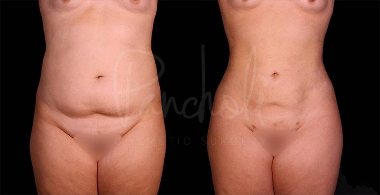 before and after liposuction of the stomach female patient front view case 8093