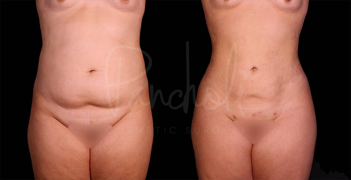 before and after liposuction of the stomach female patient front view case 8093