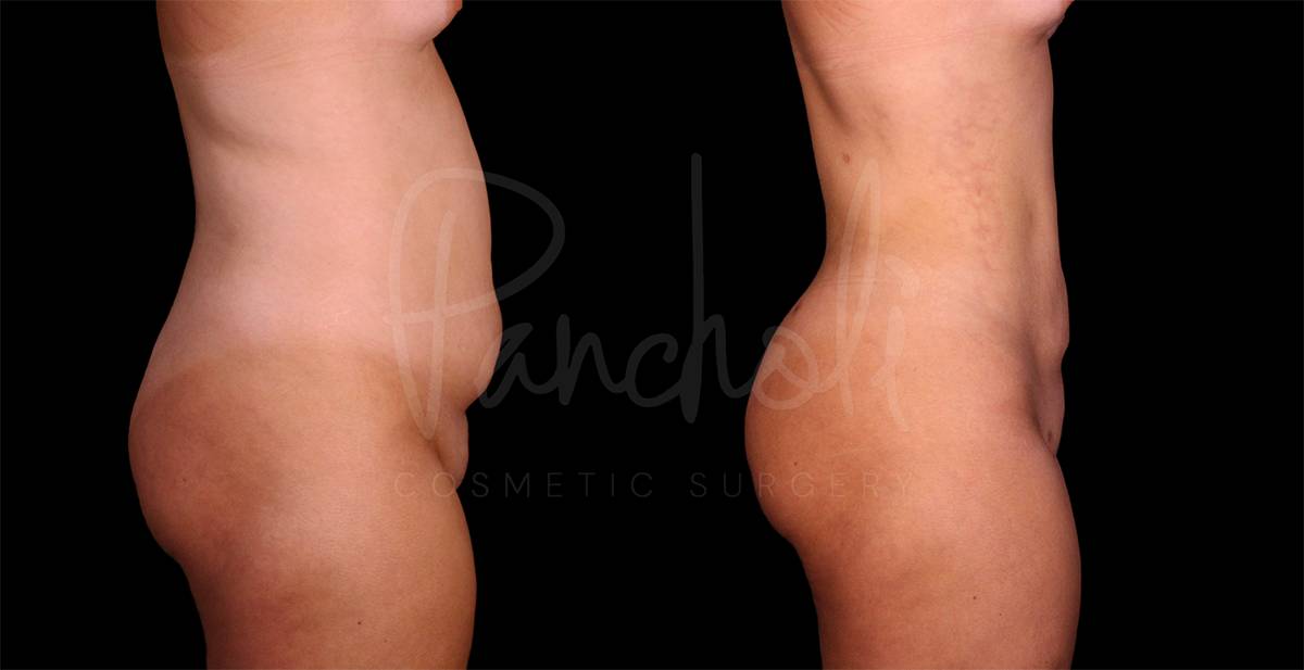 before and after liposuction of the stomach female patient side view case 8093