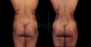 before and after liposuction in the stomach female patient back view case 8287