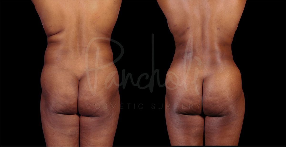 before and after liposuction in the stomach female patient back view case 8287