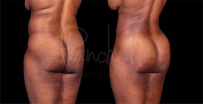 before and after liposuction in the stomach female patient 2nd angle view case 8287