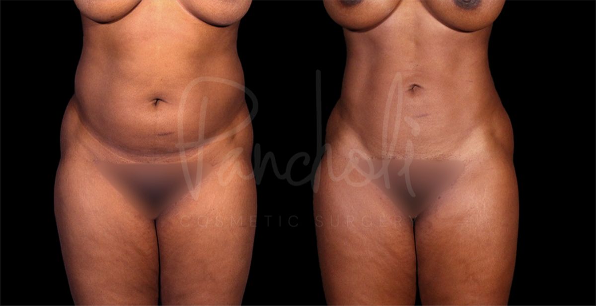before and after liposuction in the stomach female patient front view case 8287