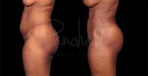 before and after liposuction in the stomach female patient side view case 8287