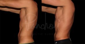 before and after liposuction on the abdomen male patient side view case 8305