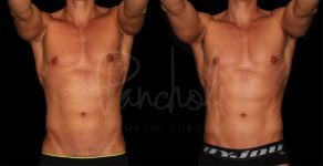 before and after liposuction on the abdomen male patient front view case 8305