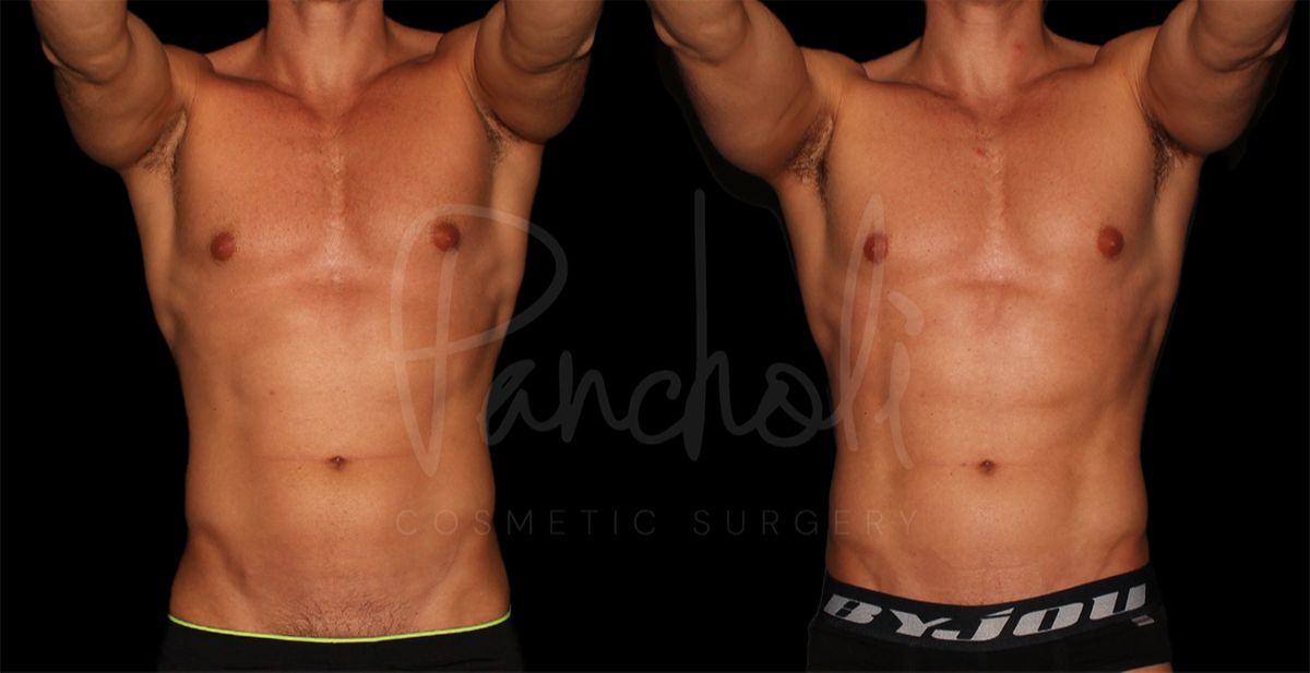 before and after liposuction on the abdomen male patient front view case 8305