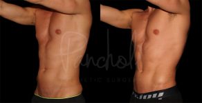 before and after liposuction on the abdomen male patient angle view case 8305