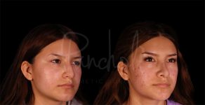 before and after rhinoplasty angle view female patient case 8310
