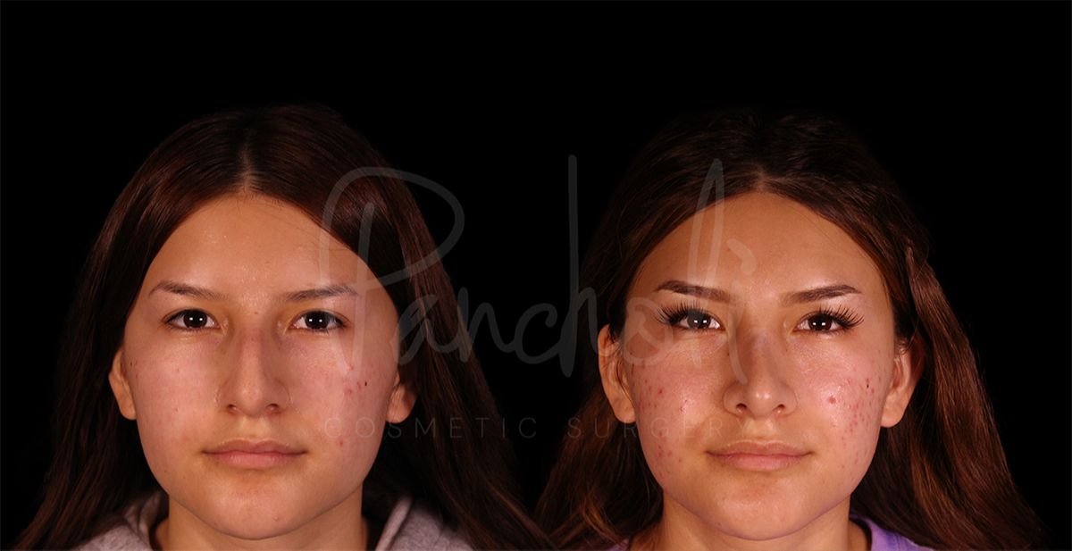 before and after rhinoplasty front view female patient case 8310
