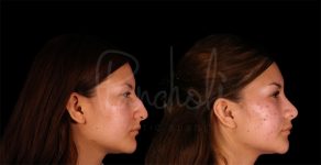 before and after rhinoplasty side view female patient case 8310