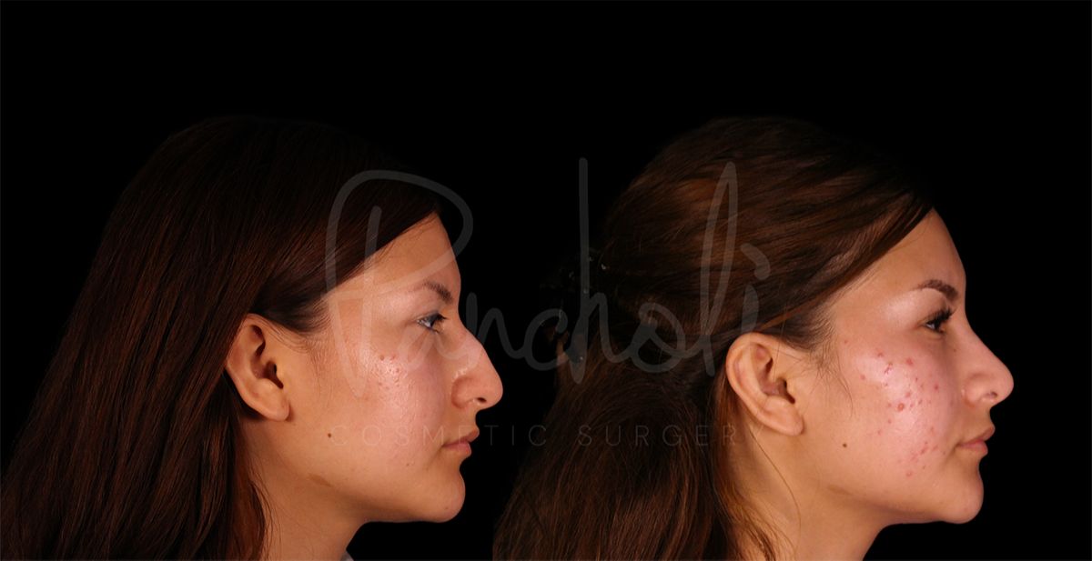 before and after rhinoplasty side view female patient case 8310