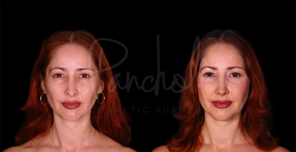 before and after rhinoplasty front view female patient case 8314