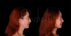 before and after rhinoplasty side view female patient case 8314