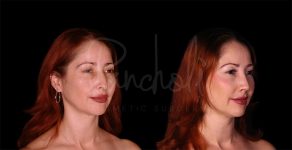 before and after rhinoplasty angle view female patient case 8314