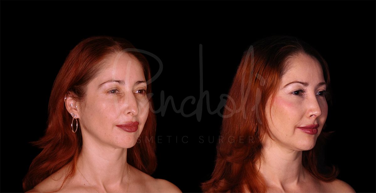 before and after rhinoplasty angle view female patient case 8314
