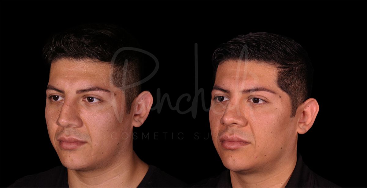 before and after rhinoplasty angle view male patient case 8318
