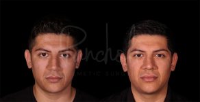 before and after rhinoplasty front view male patient case 8318