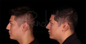 before and after rhinoplasty side view male patient case 8318