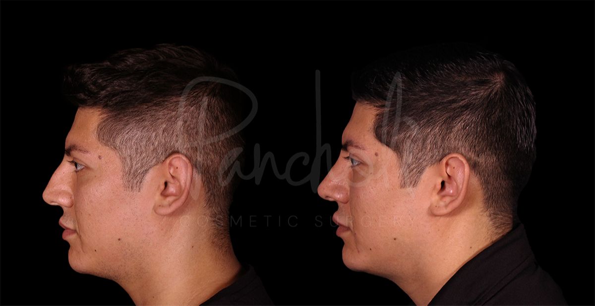before and after rhinoplasty side view male patient case 8318