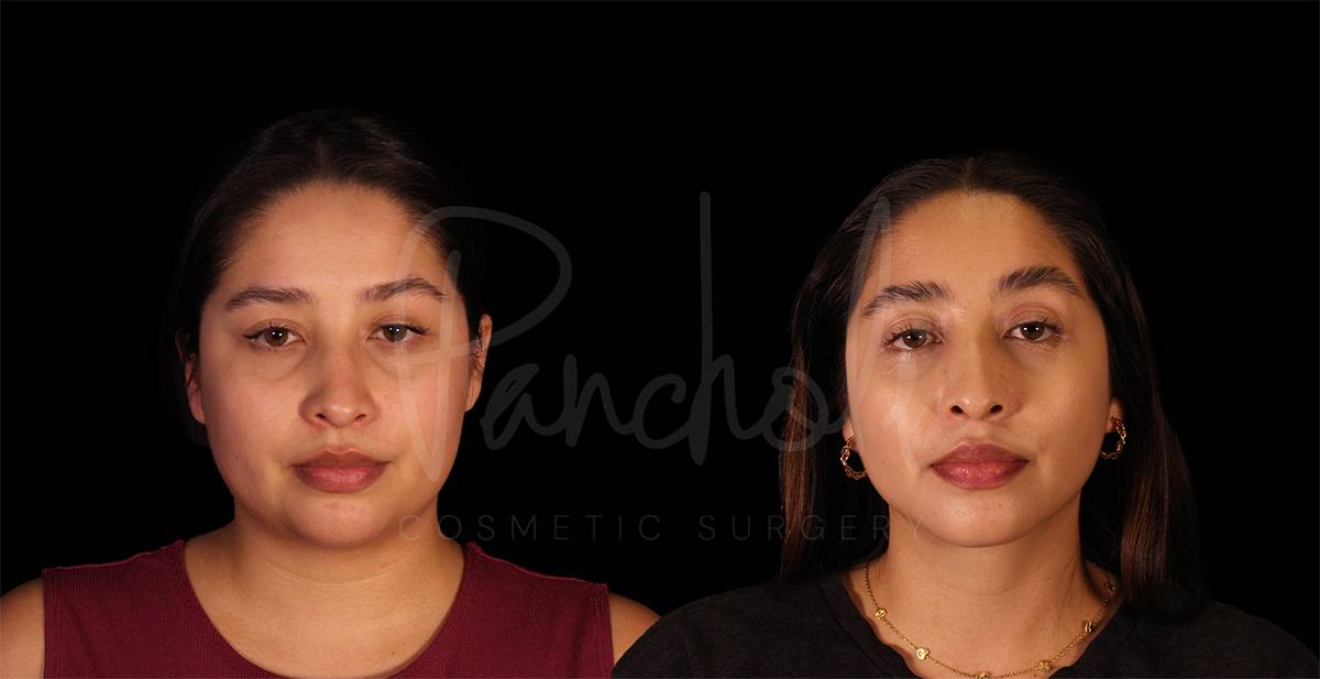 submentoplasty--8144