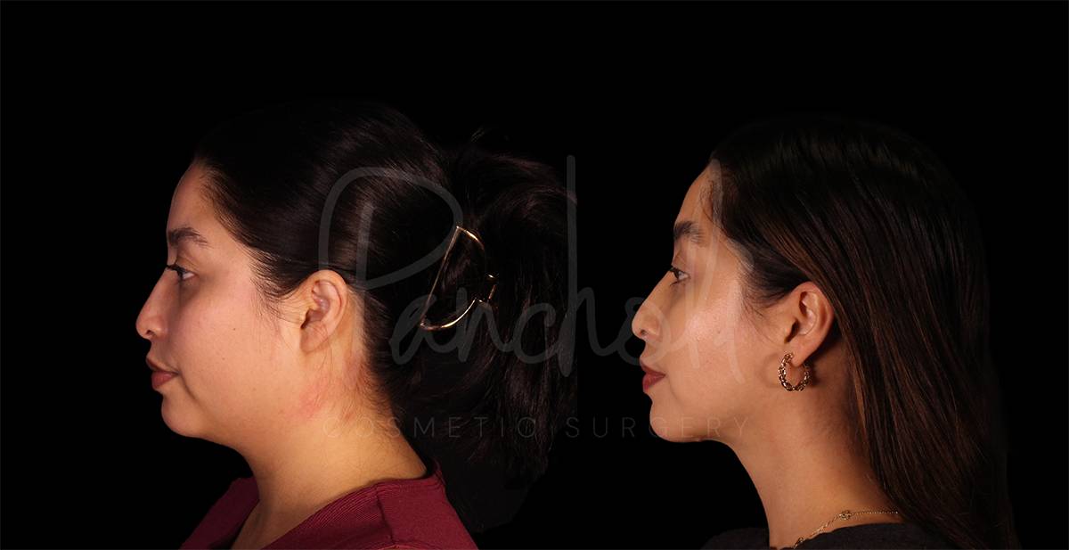 submentoplasty--8145