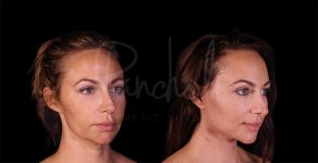 before and after lower Face and Neck Lift angle view female patient case 8448