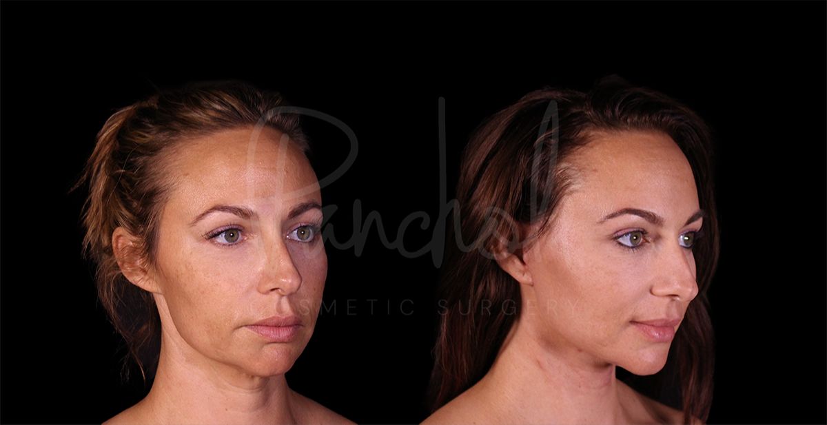 before and after lower Face and Neck Lift angle view female patient case 8448