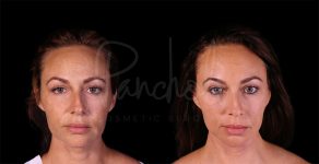 before and after lower Face and Neck Lift front view female patient case 8448