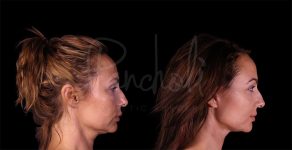 before and after lower Face and Neck Lift side view female patient case 8448