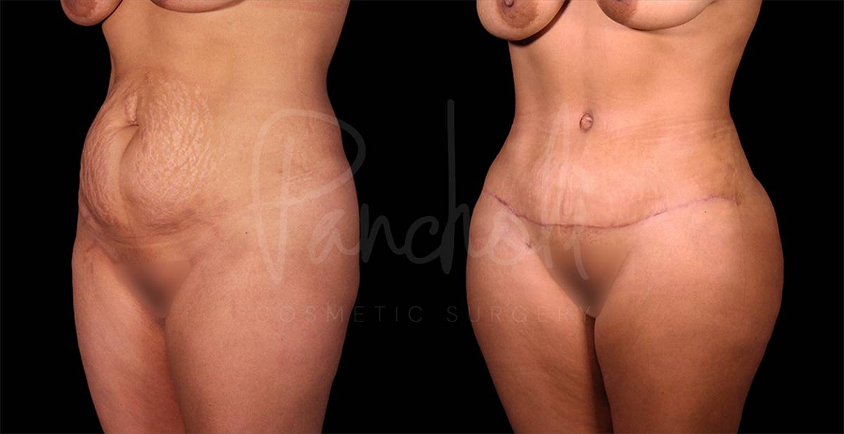 before and after female tummy tuck with lipo and fat transfer angle view