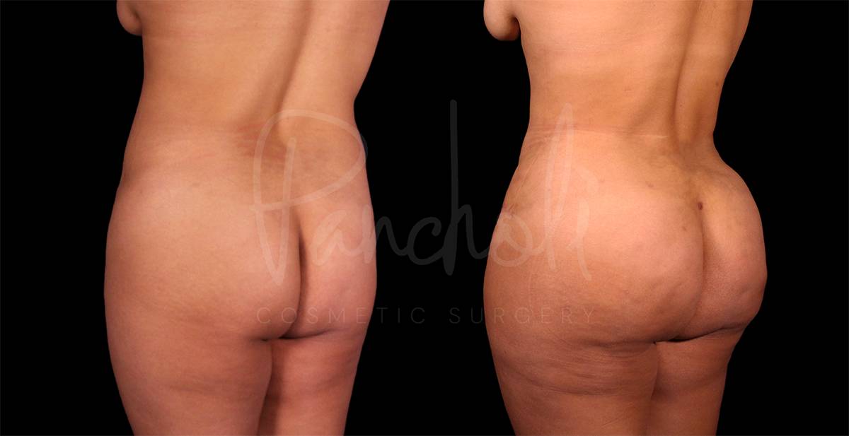 before and after female tummy tuck with lipo and fat transfer back angle view