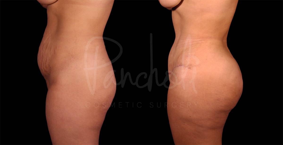 before and after female tummy tuck with lipo and fat transfer side view
