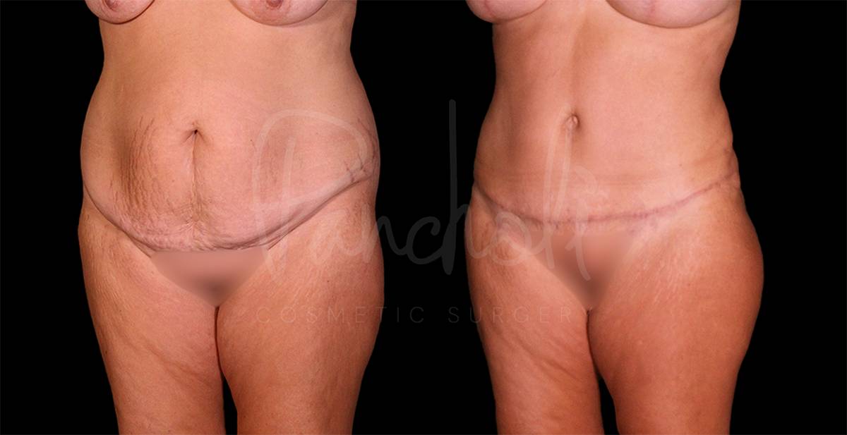 before and after female tummy tuck with lipo angle view case 8119