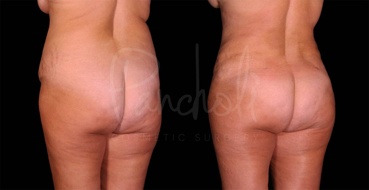 before and after female tummy tuck with lipo back angle view case 8119