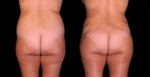 before and after female tummy tuck with lipo back view case 8119