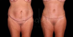 before and after female tummy tuck with lipo front view case 8119