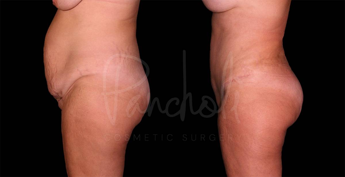 before and after female tummy tuck with lipo side view case 8119