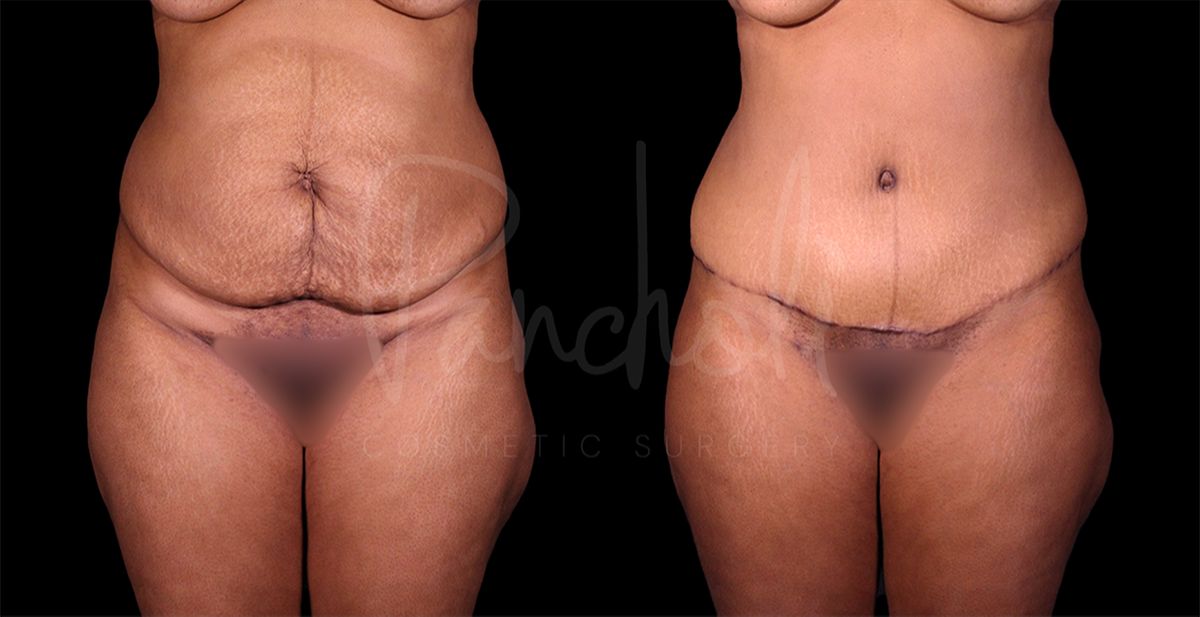 before and after Abdominoplasty with Liposuction front view female patient case 8322