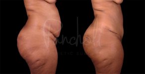 before and after Abdominoplasty with Liposuction side view female patient case 8322