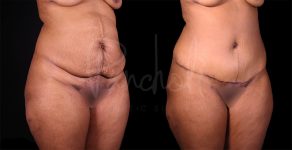 before and after Abdominoplasty with Liposuction angle view female patient case 8322
