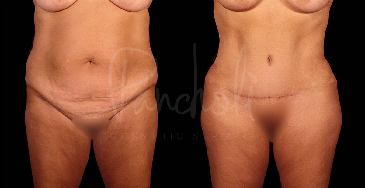 before and after Abdominoplasty, Liposuction and BBL front view female patient case 9330
