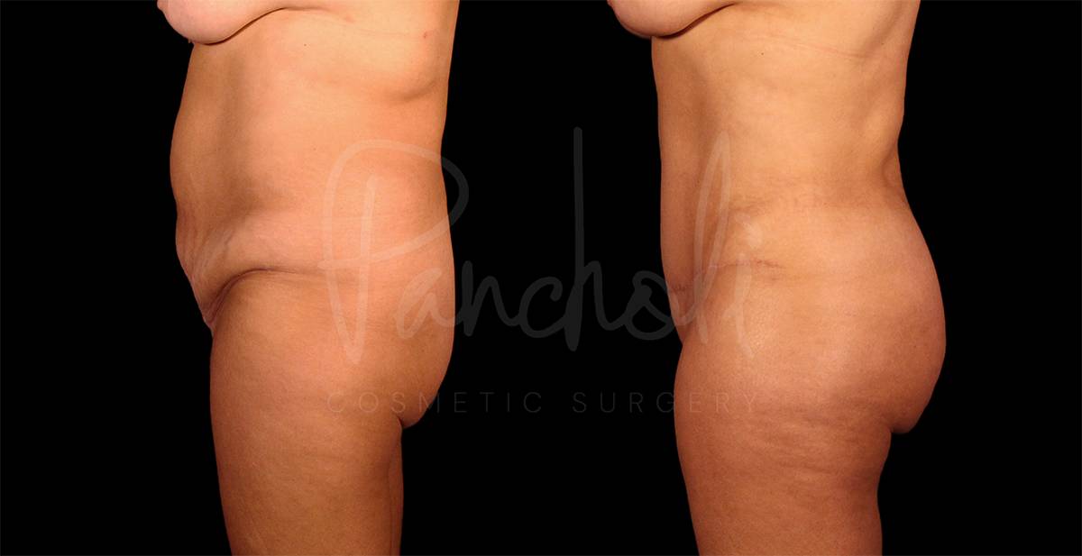 before and after Abdominoplasty, Liposuction and BBL side view female patient case 9330